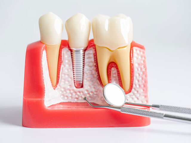 Impianto-dentale-struttura